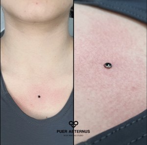 Dermal anchor piercing vstavljen v Puer Aeternus studiu v Sežani